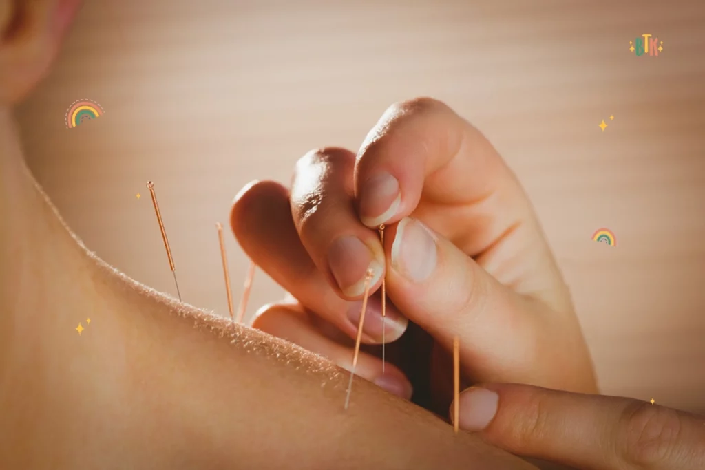 What Are the Benefits of Pregnancy Acupuncture